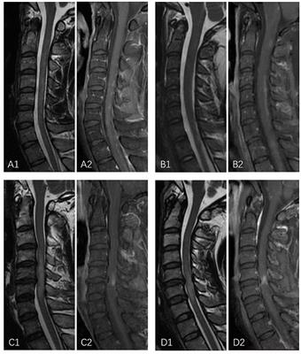 Differences of spinal cord gadolinium enhancement features of neuromyelitis optica spectrum disorder and long-segment degenerative cervical myelopathy